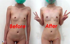 インドネシアの豊胸手術ビフォアフター・・・何が変わった？？